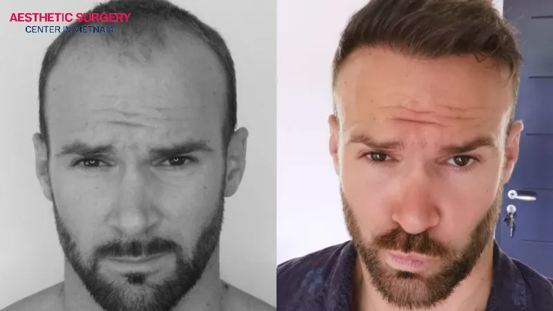 Choosing a reputable hair transplant clinic will give you a higher chance of success