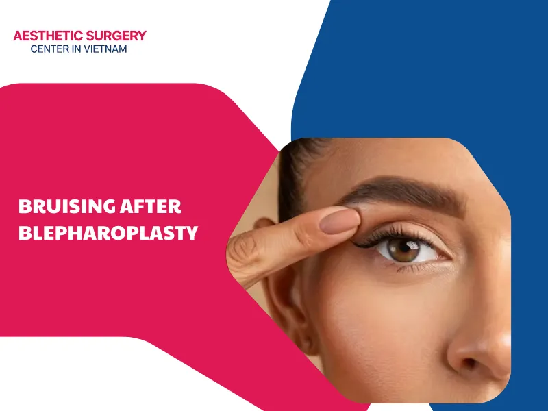 Causes of bruising after blepharoplasty and how to manage it
