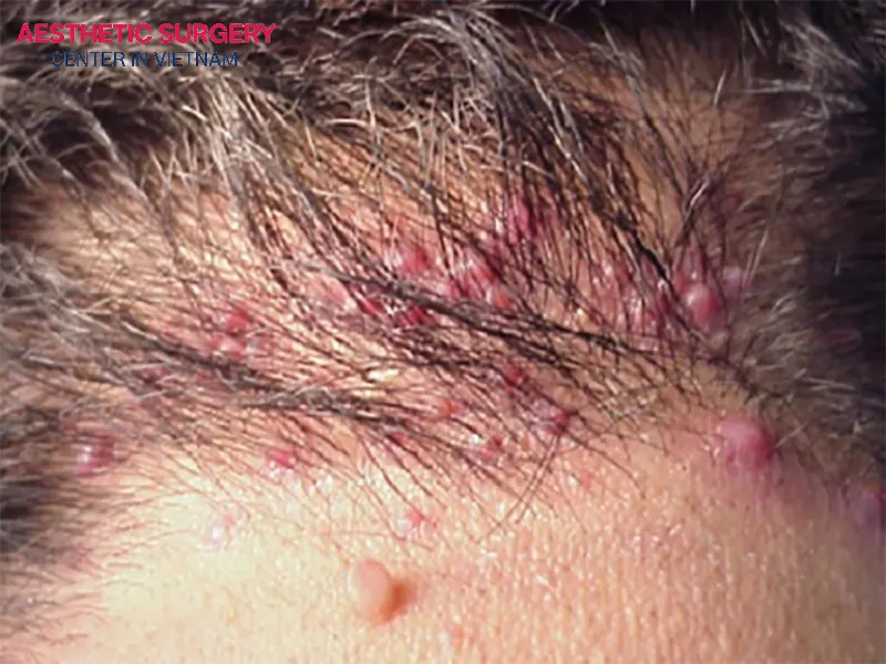 Prolonged infection after a hair transplant is a sign of a bad hair transplant.