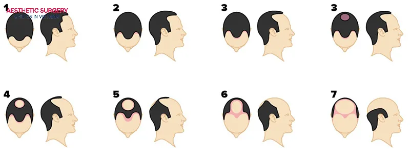 The Norwood scale has 7 stages of male baldness, and each stage usually requires a different number of grafts.