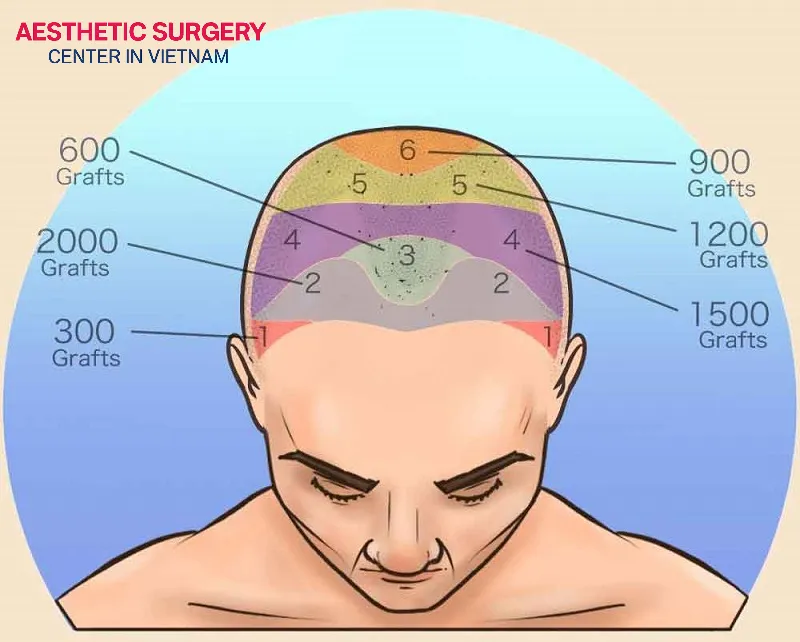 Each area of the scalp requires a different number of hair grafts.