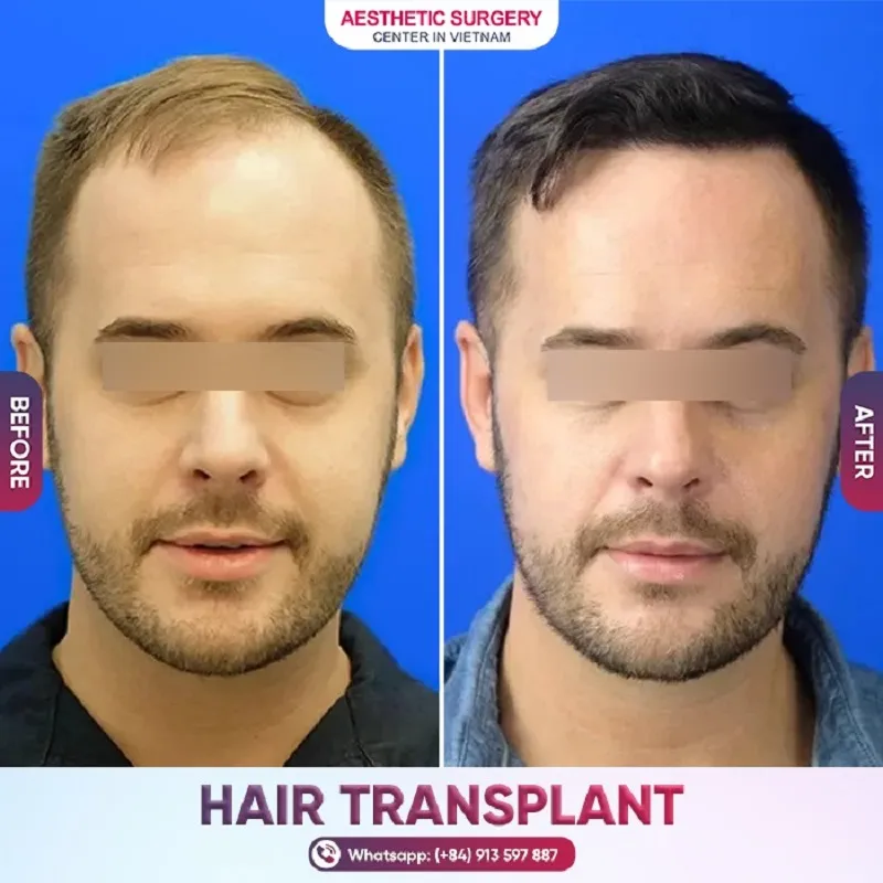 When choosing a hair transplant to treat baldness, you need to go to a reputable clinic to ensure high effectiveness and safety.