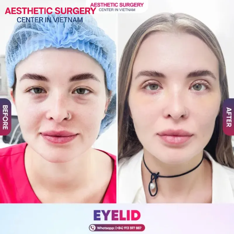 Before-and-after images of a girl after eyelid stitching at Aesthetic Surgery Vietnam