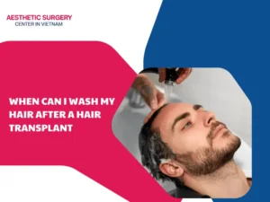 When can I wash my hair after a hair transplant?