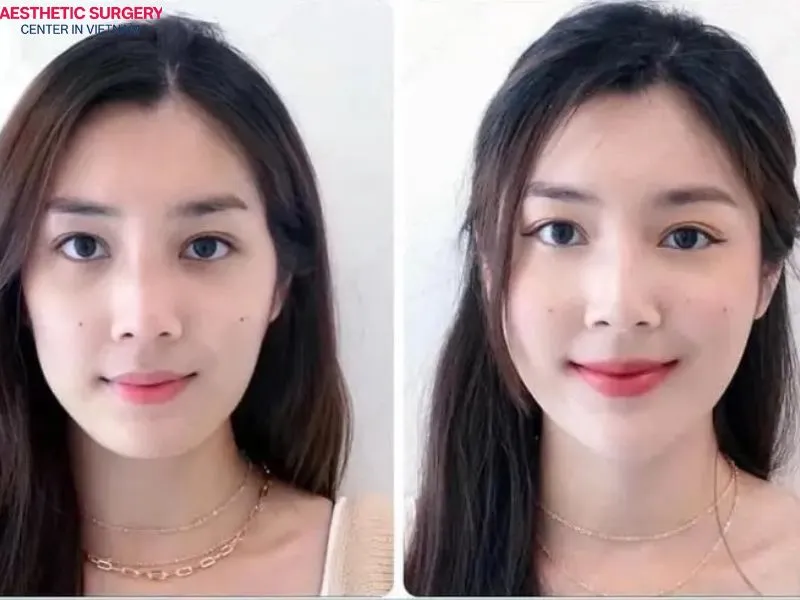 Fillers help quickly correct sunken facial imperfections with a non-invasive approach.