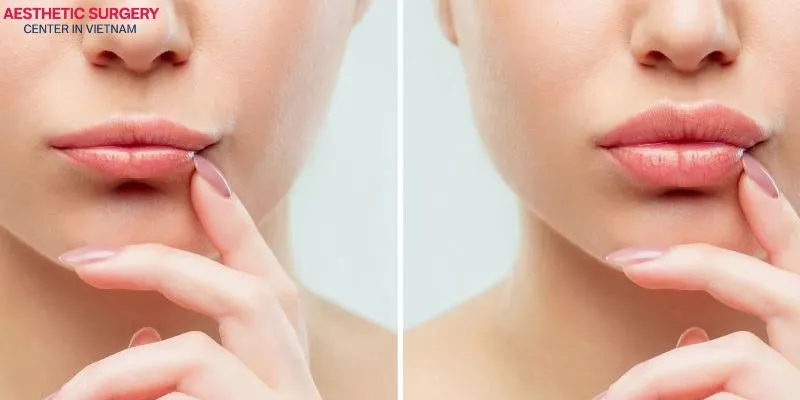 Filler injections can help enhance lip volume, giving patients fuller and more plump-looking lips.