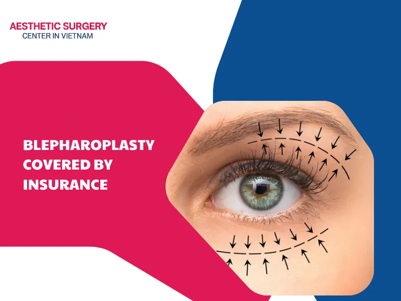 Is blepharoplasty covered by insurance