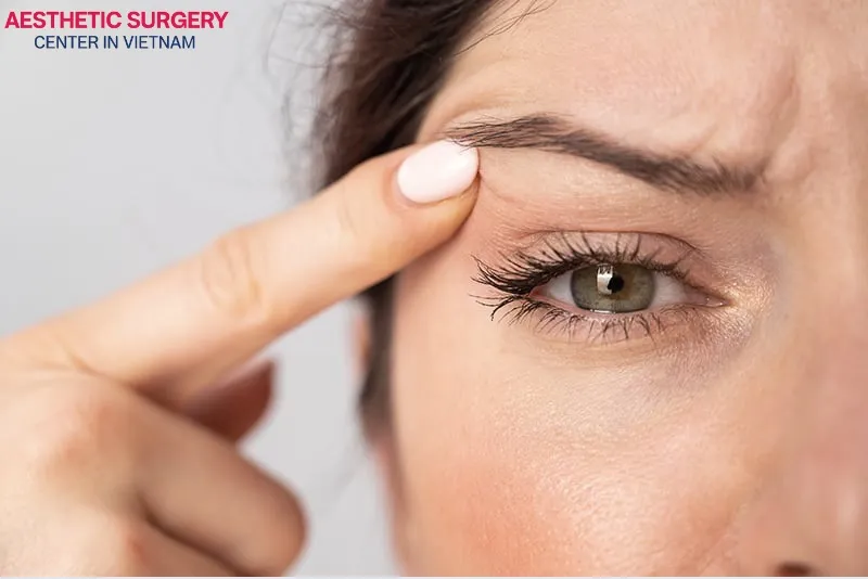 Blepharospasm can cause the eyelids to close slightly, squeeze tightly, or even prevent the eyes from opening fully.