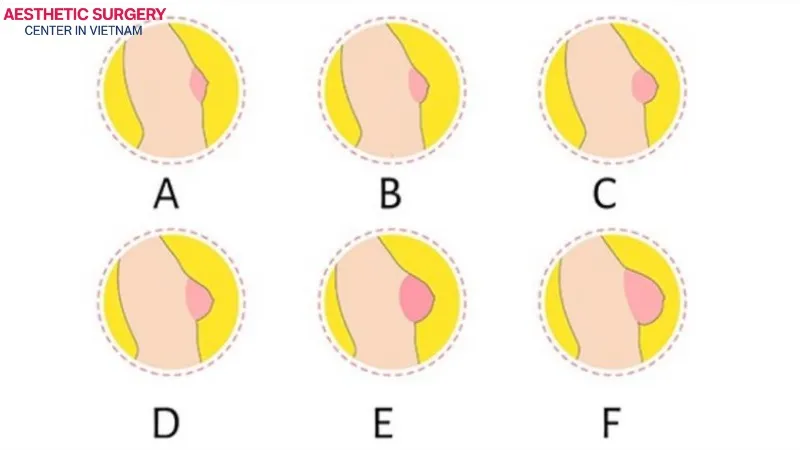 There are many different breast cup sizes, depending on each person’s measurements.