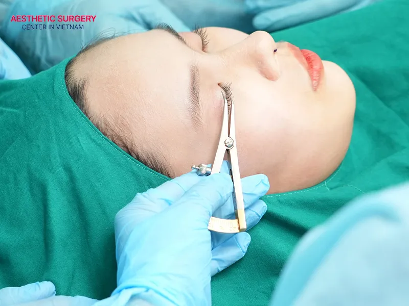 The surgeon’s professional skill plays an important role in minimizing bruising after blepharoplasty.