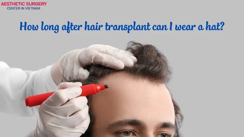 You can start wearing a hat again about 10–14 days after a hair transplant.