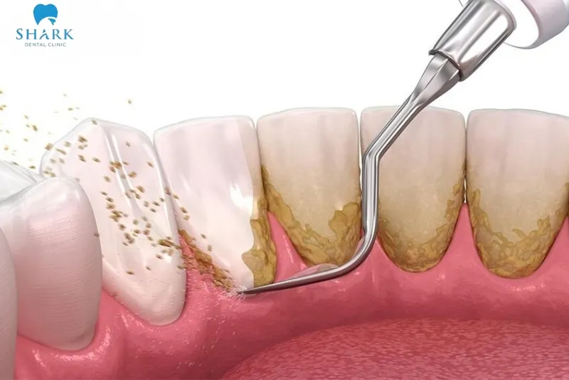 Because tartar has a hard structure and adheres firmly to teeth, it is best to visit a dental clinic to have it removed using specialized professional instruments