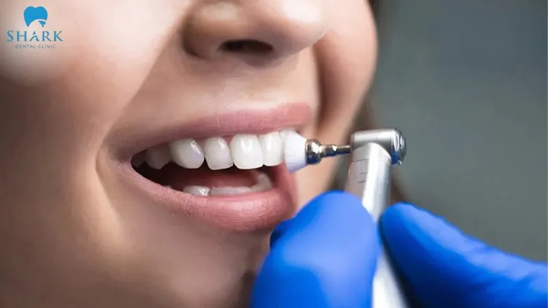 Teeth scaling & polishing helps make teeth cleaner and brighter
