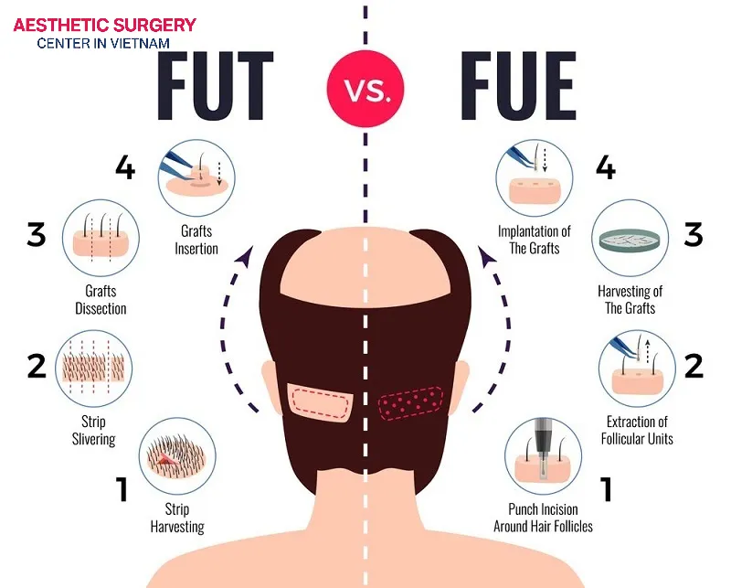 FUE is typically more expensive than FUT—often 30% or even double the price.