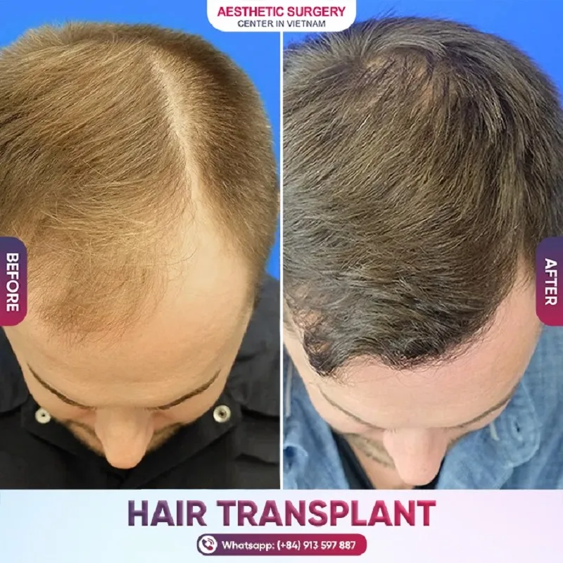 Before and after photos of the patient’s hair transplant