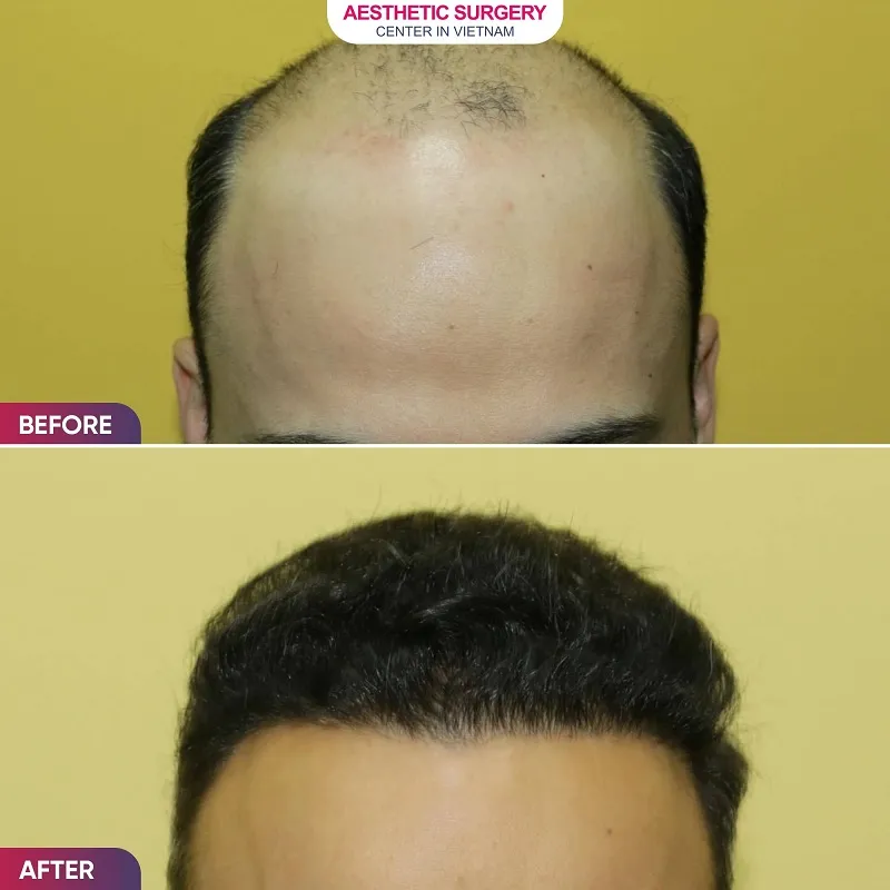 The patient’s bald area has grown back thick and full after the hair transplant.