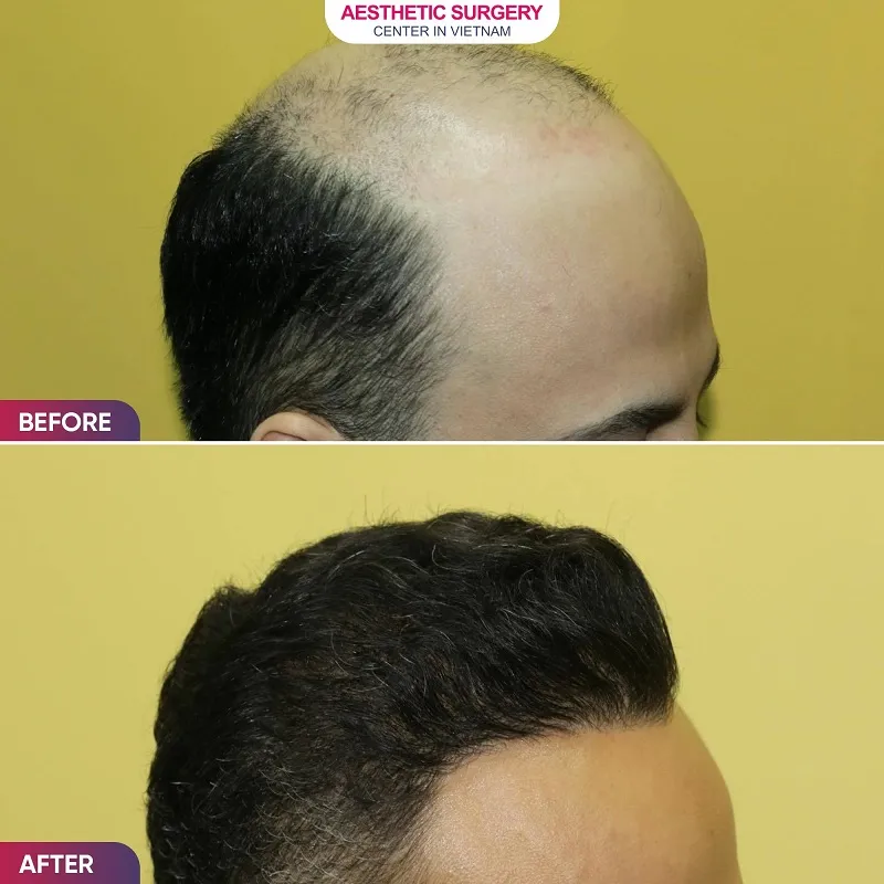 The transplanted hair has grown back naturally, restoring a youthful look for men.