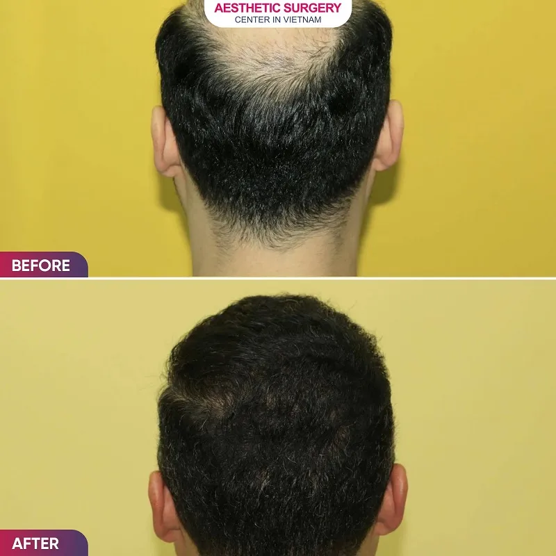 The patient’s bald crown area has been fully restored after the hair transplant procedure.