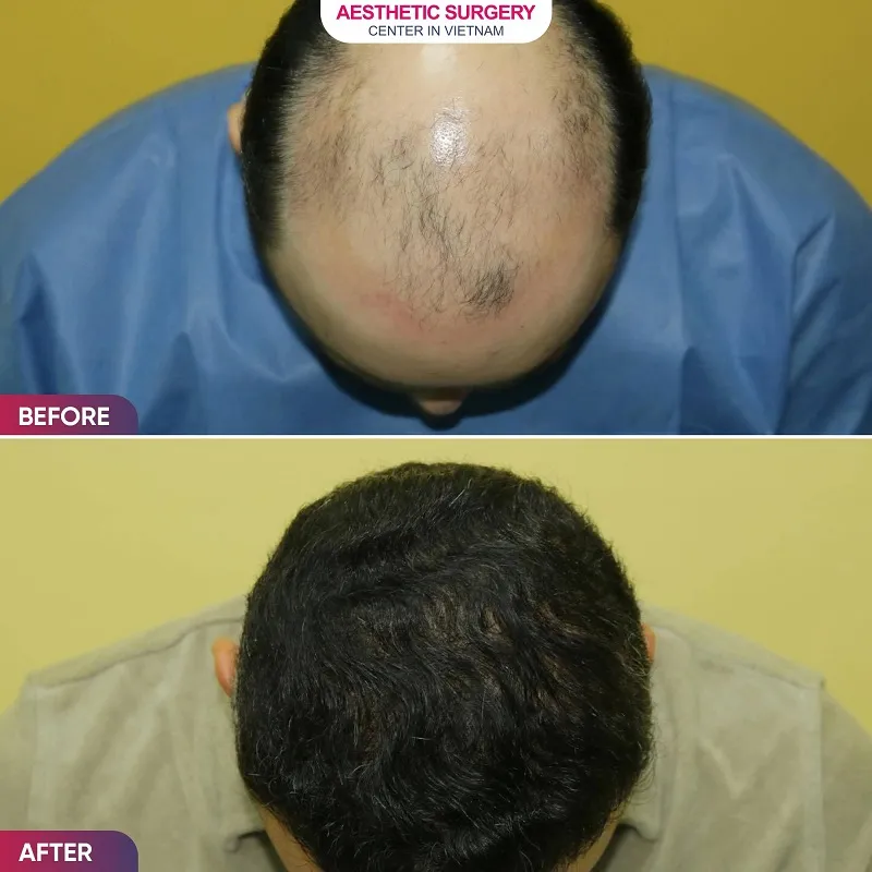 Severe baldness on the crown was completely recovered following the hair transplant.