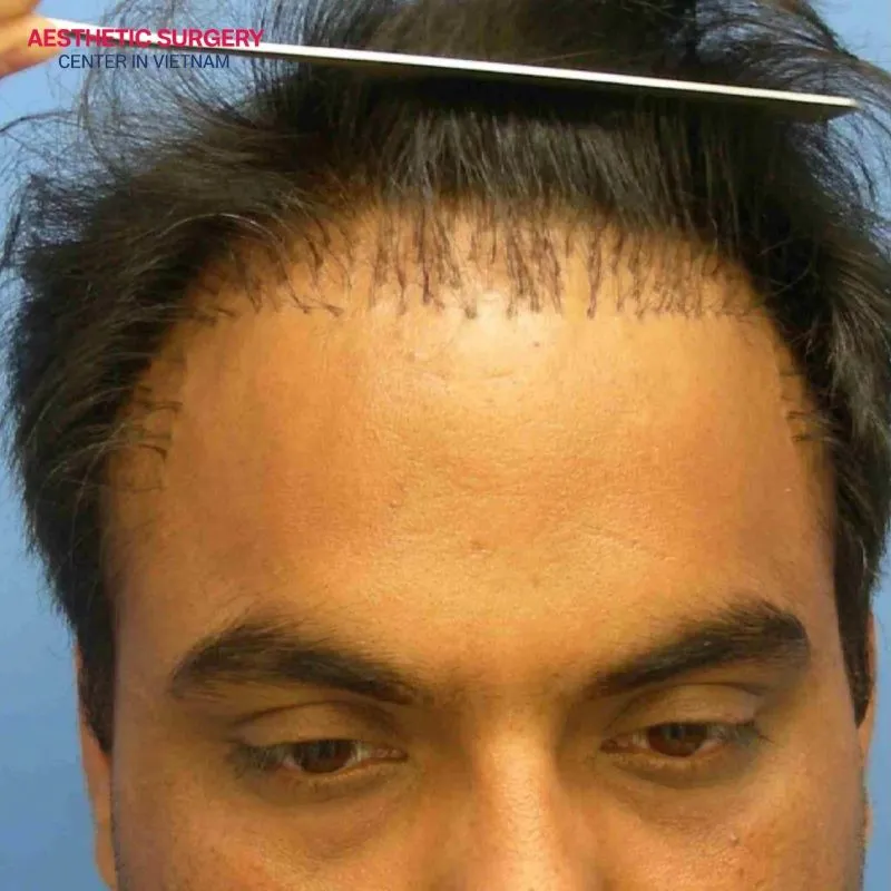 It helps create the appearance of thick hair but requires careful scalp care, avoiding harsh brushing or vigorous washing.