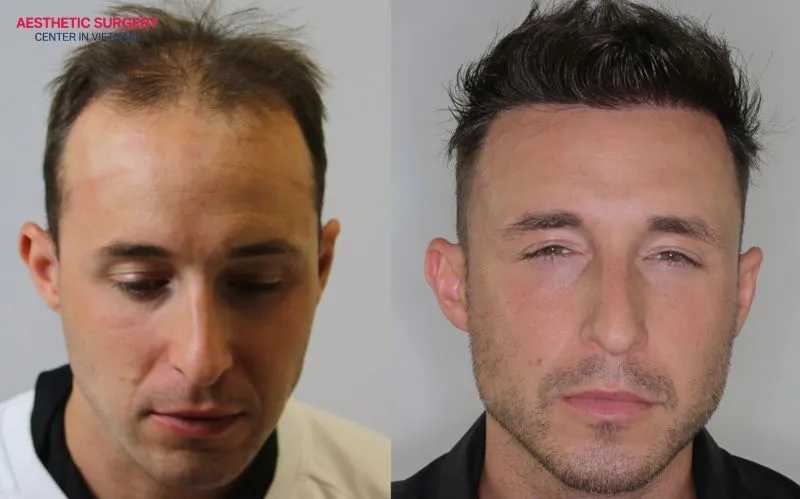 Hair transplants use the patient’s own hair follicles, ensuring high compatibility and allowing the hair to grow strong and healthy like natural hair.