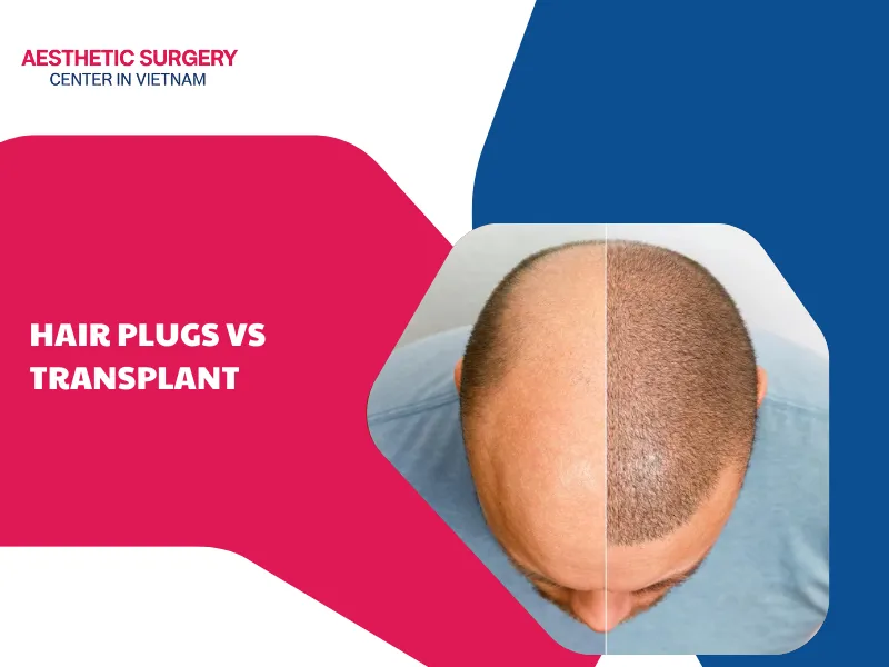 Hair plugs vs transplant – Detailed comparison