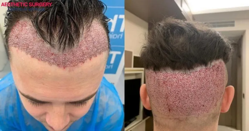 Infection is a very rare occurrence after a hair transplant.