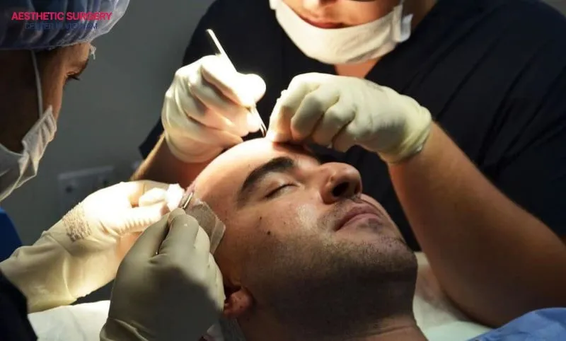 The hair transplant technique also greatly affects swelling after the procedure.