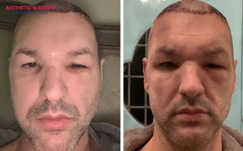 Hair transplant swelling is usually not a dangerous sign but a completely normal reaction.