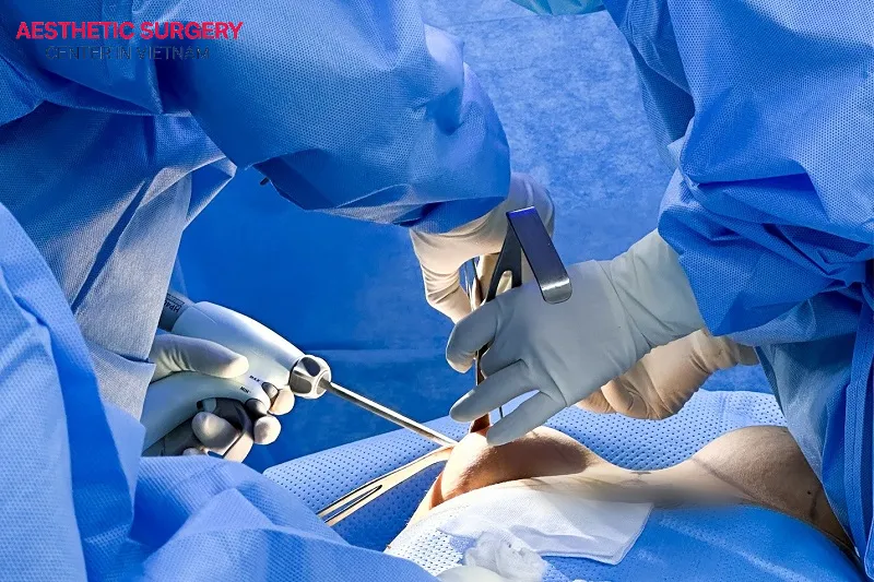 If the surgeon does not perform proper hemostasis, it can easily lead to hematoma formation.