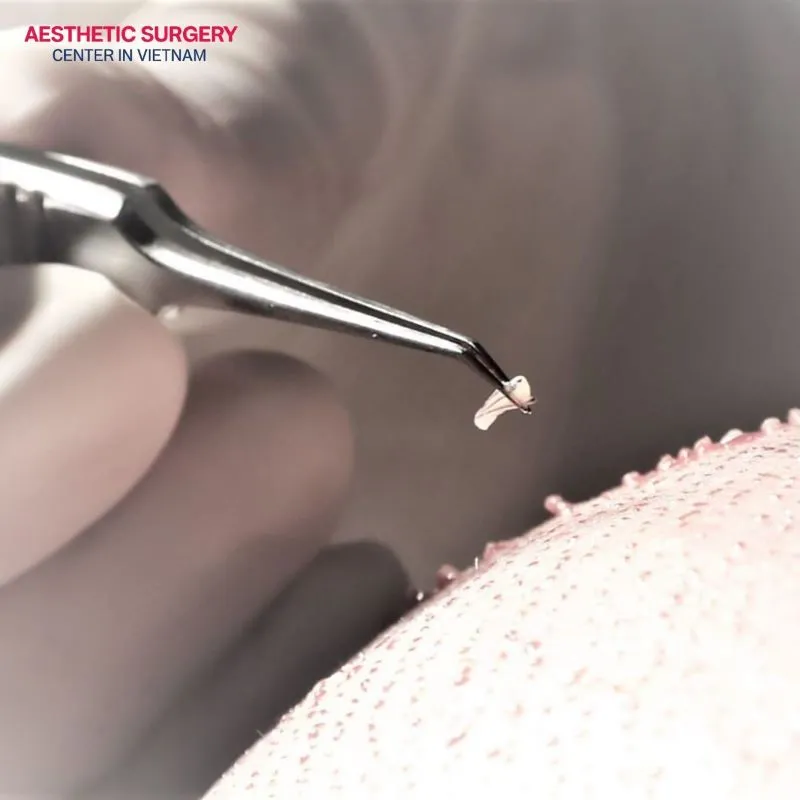 How long does a hair transplant take? The duration of a hair transplant procedure usually depends on the area to be restored, the severity of hair loss, and the number of grafts required.