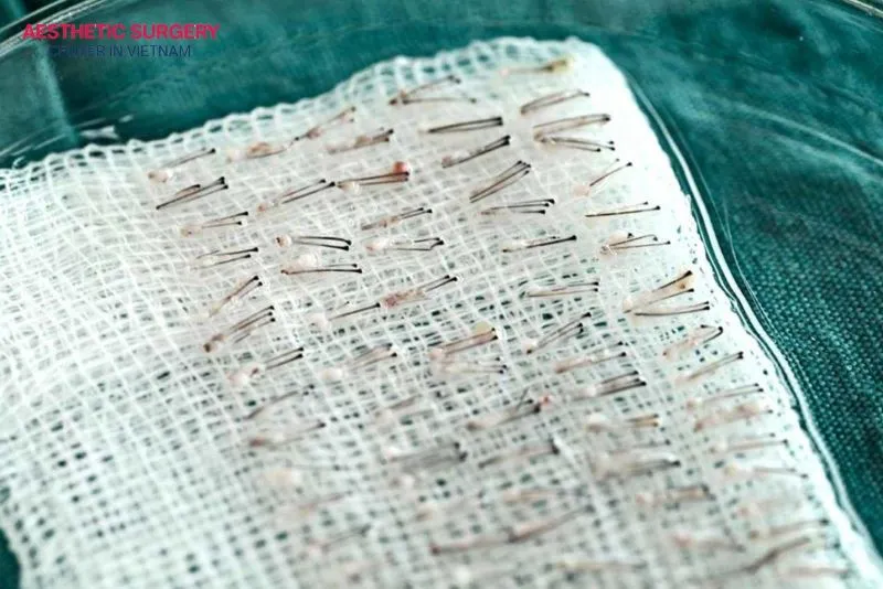 The duration of a hair transplant also depends on the method used and the graft extraction process.