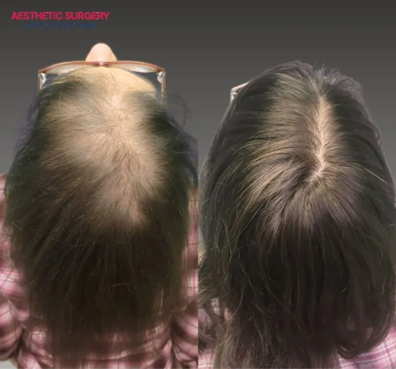 Every step of the procedure is carefully controlled to ensure your hair grows evenly and beautifully over the long term.