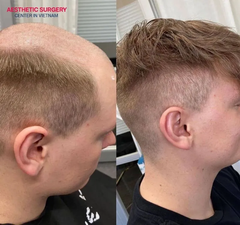 Before-and-after images of patients at Aesthetic Surgery Center show hair that grows long, healthy, and naturally beautiful over time.