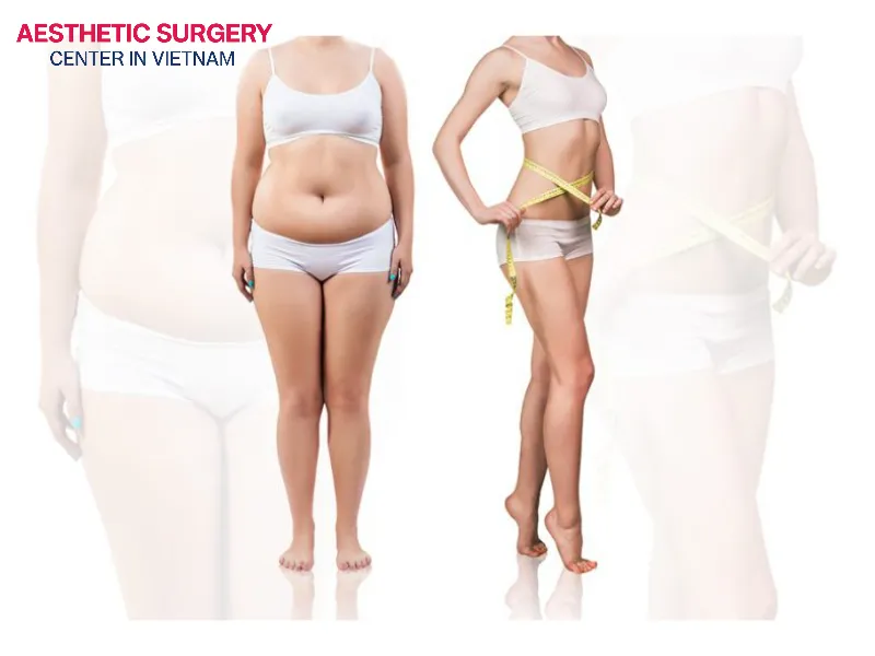 Depending on each stage, the duration of liposuction results can vary.