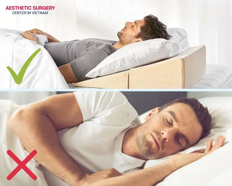 You should sleep on your back at a 30–45 degree angle to limit follicle movement and reduce swelling during the first days.