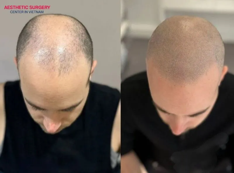 You can return to your normal sleeping position once the hair follicles have firmly connected with the scalp tissue.