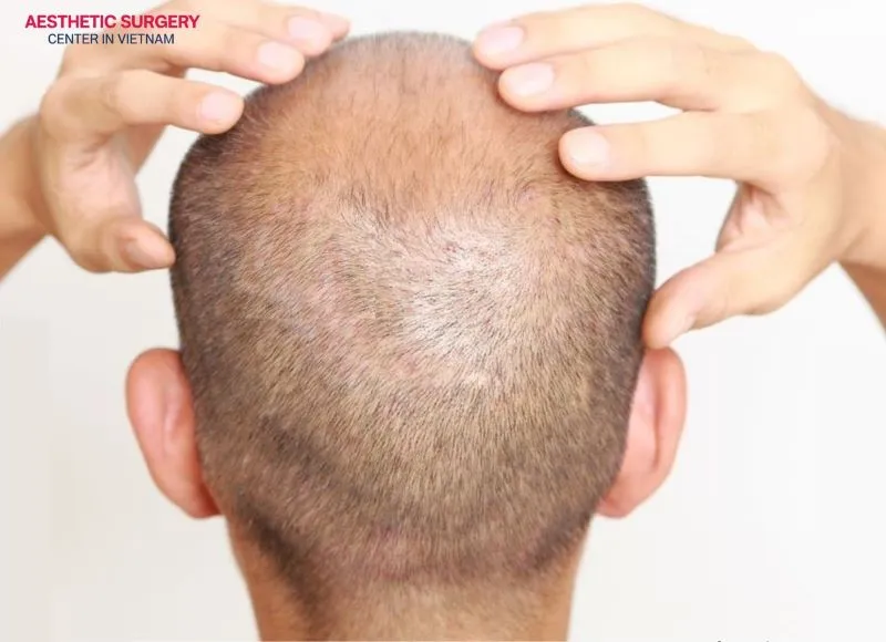 You can gently tap the area around the transplant to relieve itching and discomfort, and avoid scratching to prevent affecting the transplanted area.