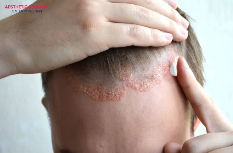 Do not use unfamiliar products on the newly transplanted scalp without your surgeon’s guidance or prescription.