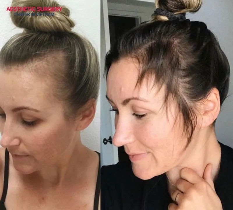 Before and after patients undergo hair transplants at Aesthetic Surgery Center