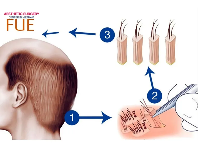 Surgeons separate each healthy hair follicle using ultra-fine instruments and implant them into thinning or balding areas of the scalp.