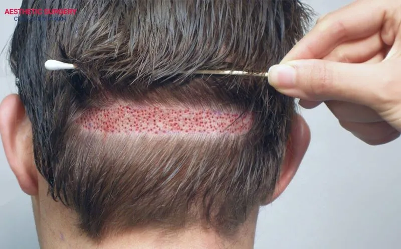 The FUT hair transplant method requires a strip of scalp containing multiple healthy hair follicles to implant into thinning or balding areas.