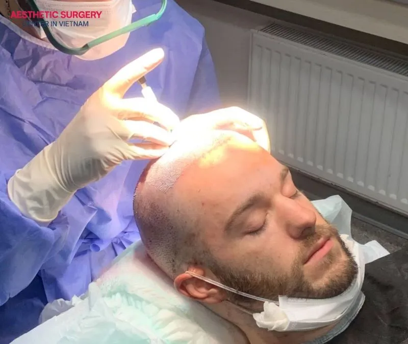 Surgeons administer local anesthesia before the hair transplant, ensuring patients feel completely comfortable or only experience slight tingling during the procedure.