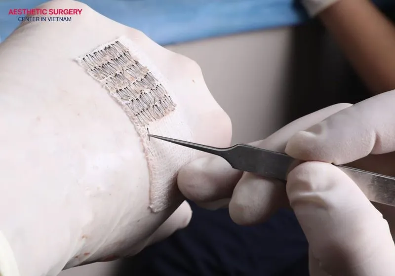 The choice of hair transplant method usually depends on several factors, including the surgeon’s technique, the number of follicles, and the patient’s needs.