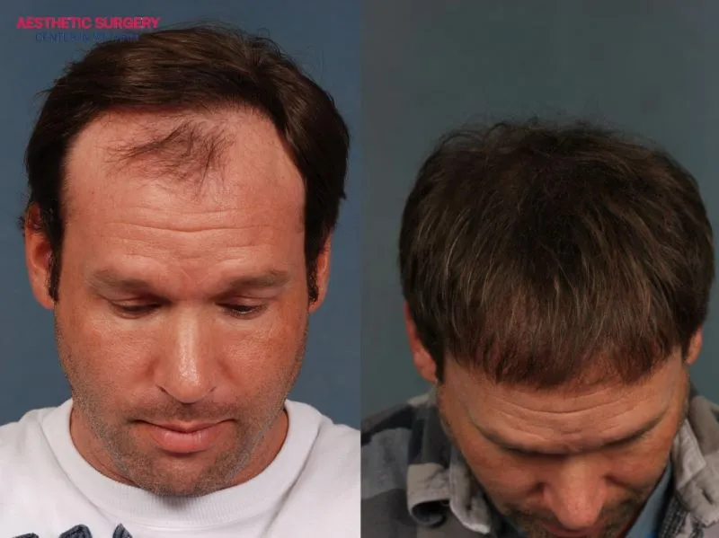 Before and after images of patients who underwent hair transplant for men at Aesthetic Surgery Center