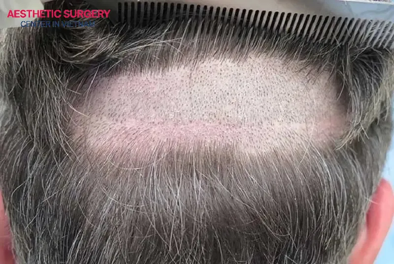 It is possible to get a hair transplant without shaving your head