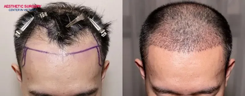 Patients with mild to moderate alopecia are excellent candidates for Non-shaven FUE