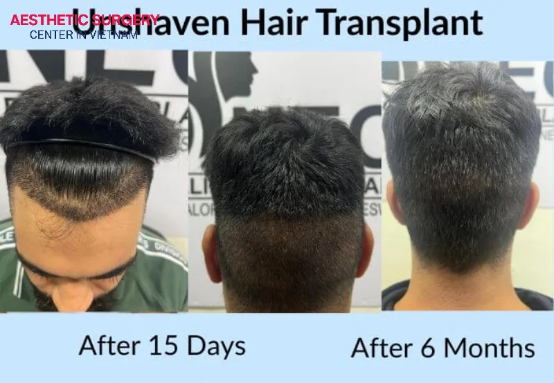 Customer results 6 months after a fully non-shaven hair transplant