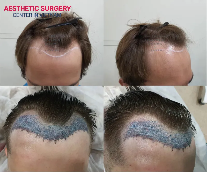 Partial shave hair transplantation is a suitable solution for both office workers and women.