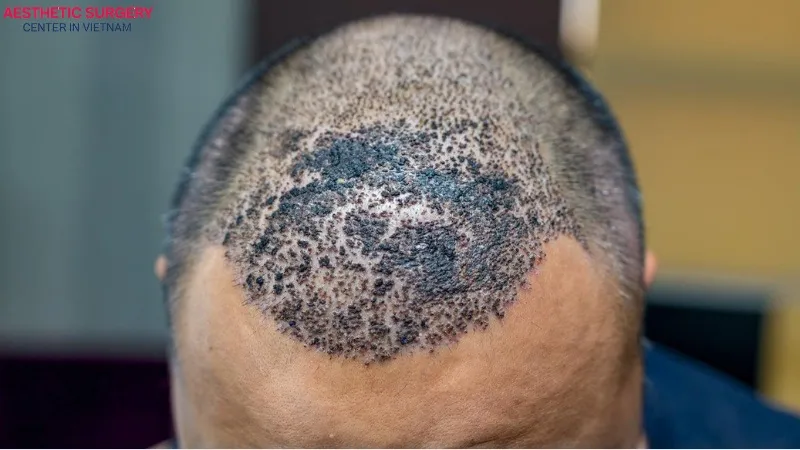 Hair transplant scabs are a natural layer that forms on the scalp after the procedure.